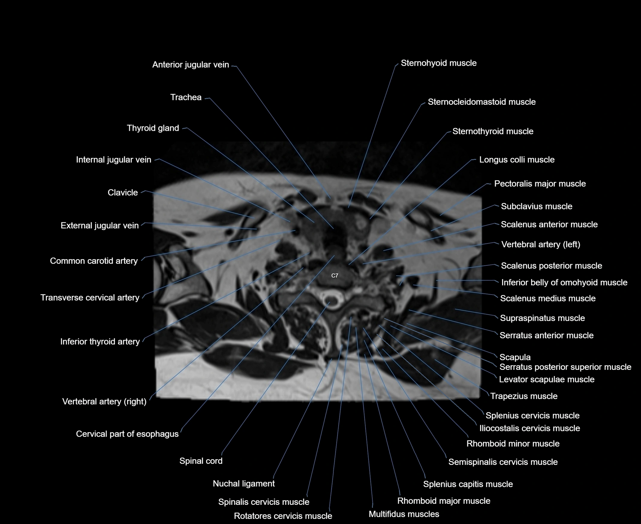 MRI Neck 3D labelled cross section anatomy axial 3t image-00001-00079.webp